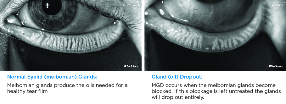 DMI-Normal-vs-MGD-Gland Comparison