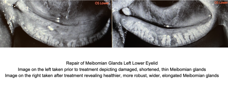 Treating MGD | The Dry Eye Treatment Center